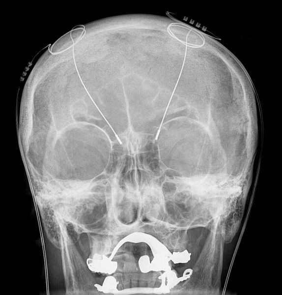 Hirnimplantate für eine Deep Brain Stimulation (Tiefe Hirnstimulation) nach der Opertation bei einem Parkinson-Patienten. Bild: Wikimedia Commons | CC BY-SA 3.0 